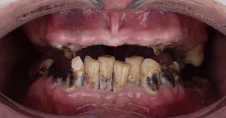 how long until a tooth infection kills you