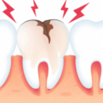 small cavity