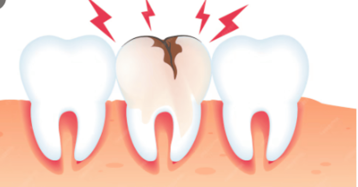 small cavity