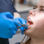 gap teeth