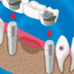dental bone graft