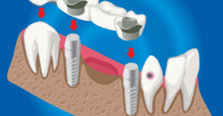 dental bone graft