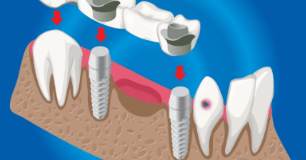 dental bone graft
