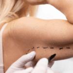 brachioplasty