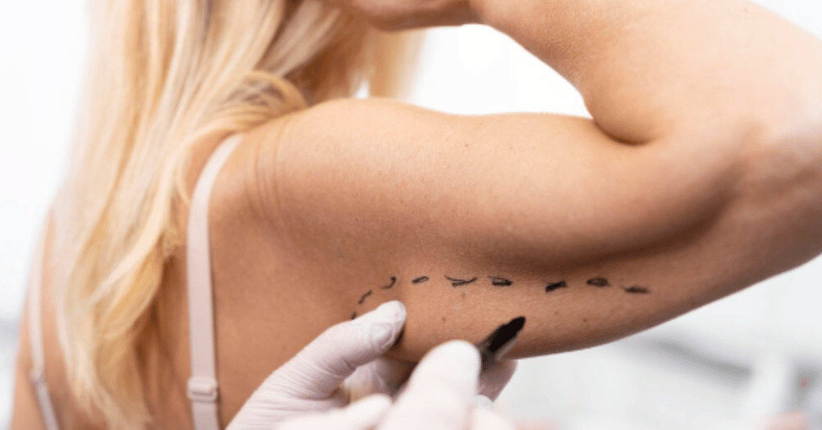 brachioplasty